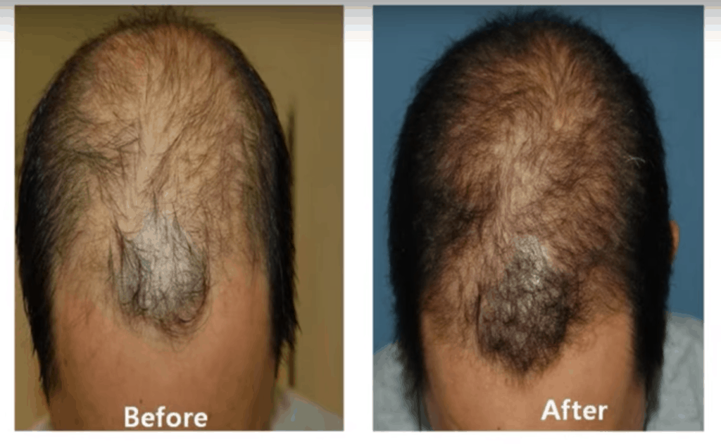 Vampire Hair Restoration