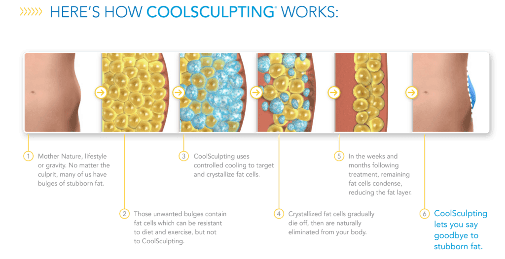 How Coolsculpting Works